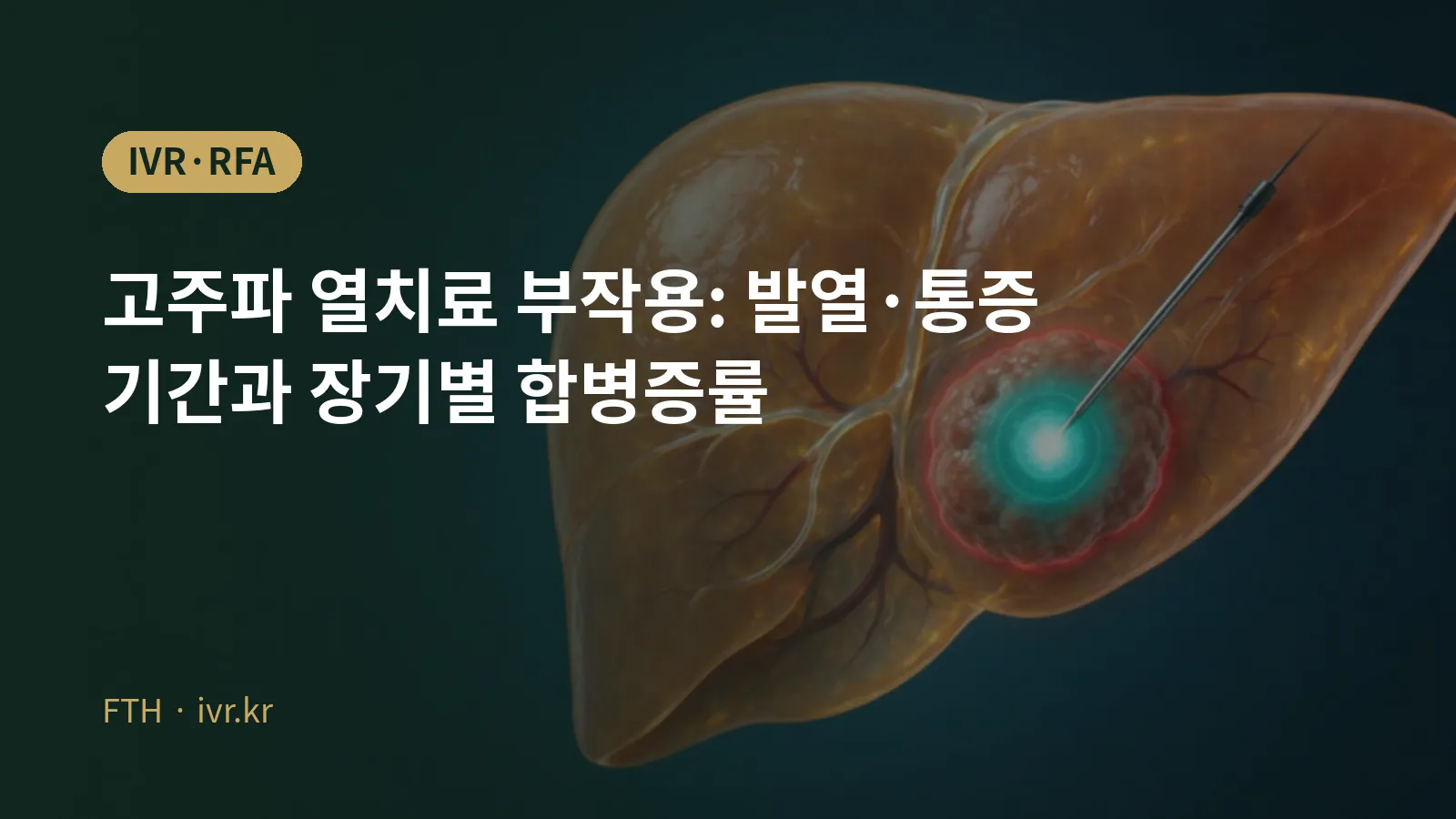Radiofrequency ablation (RFA) side effects and complications cover image